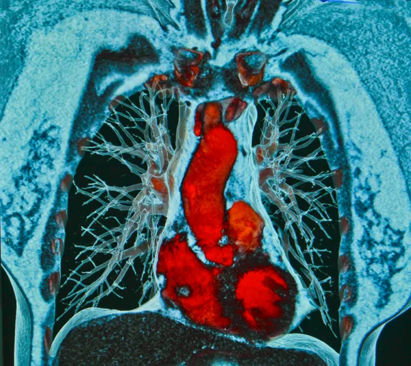 How AI Analysis of Routine CT Scans Could Help Nashville Patients Identify Hidden Heart Disease Risk Early